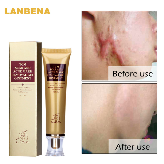 lanbena stretch mark removal