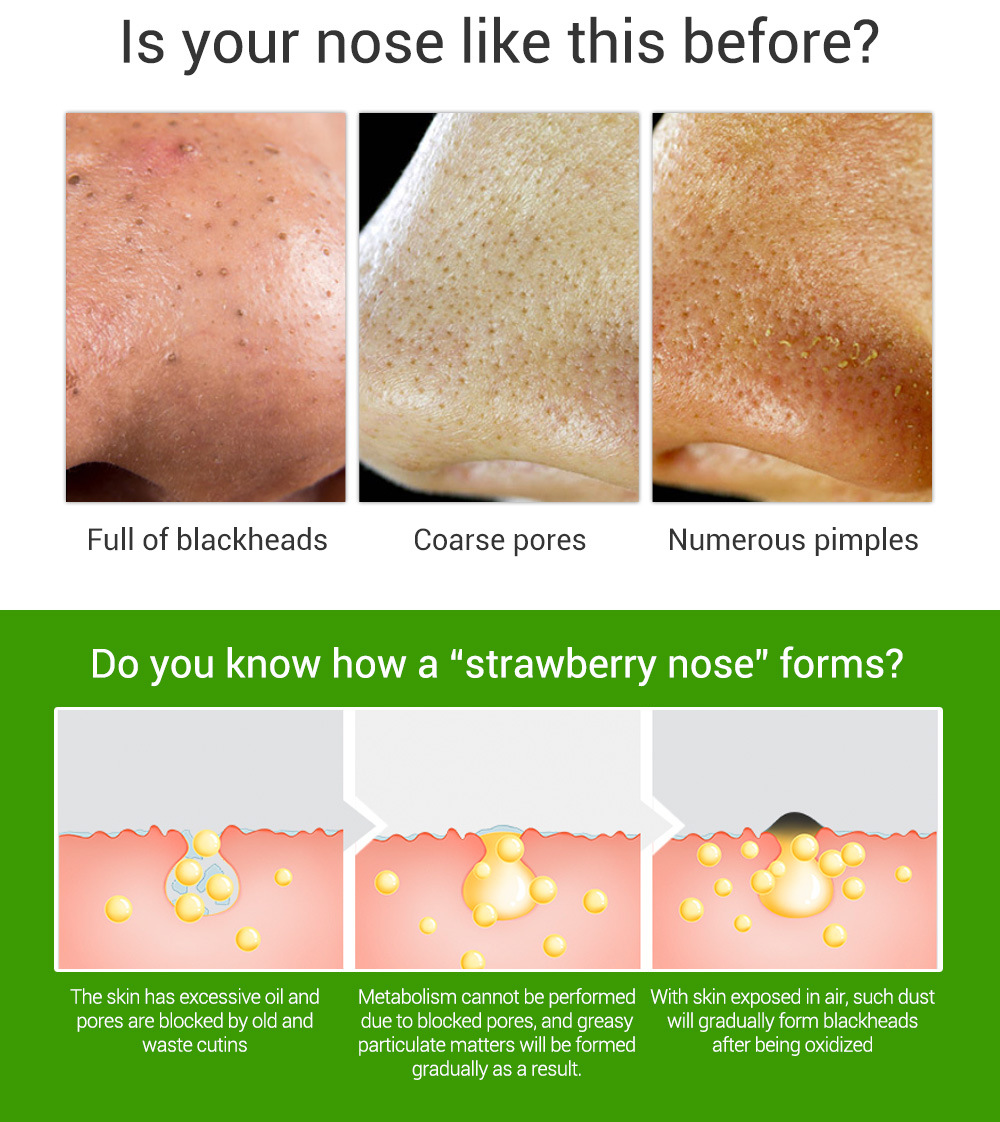 LANBENA Deep Acne Softener Blackheads Fluid Nose Blackheads for Acne R